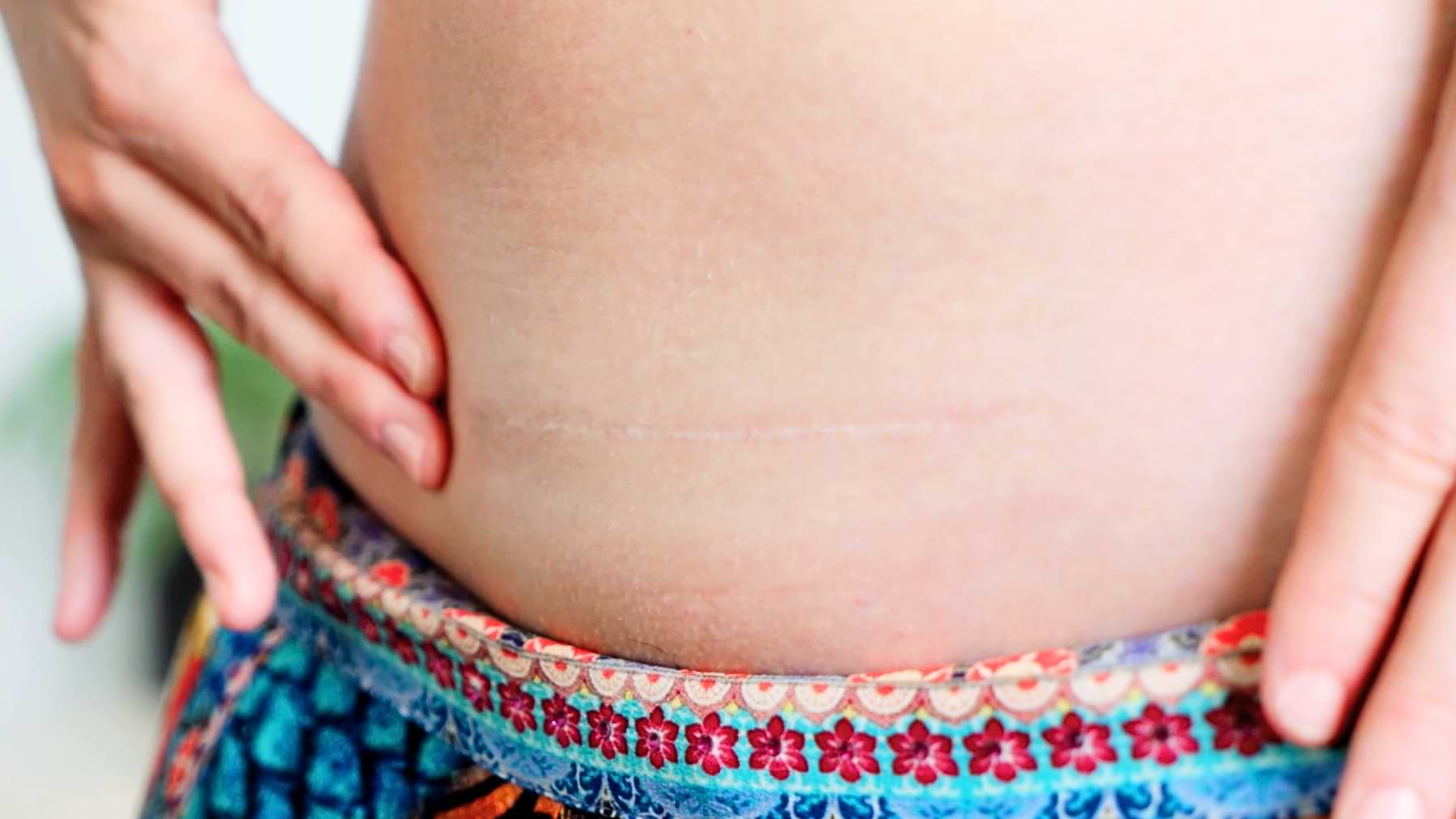 Close-up of a faint, mature scar on the lower abdomen, with hands resting on the hips of someone wearing colourful patterned clothing.
