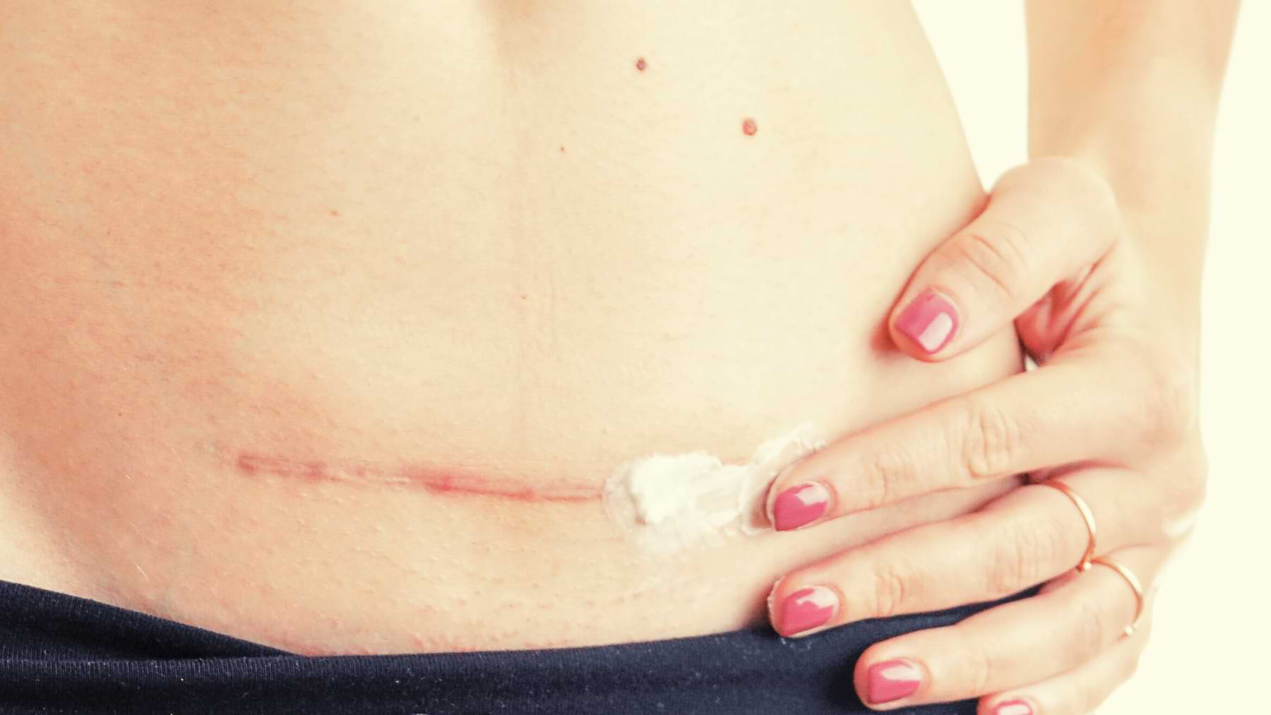 Fresh surgical scar on the lower abdomen being moisturised with cream by a person with painted fingernails.