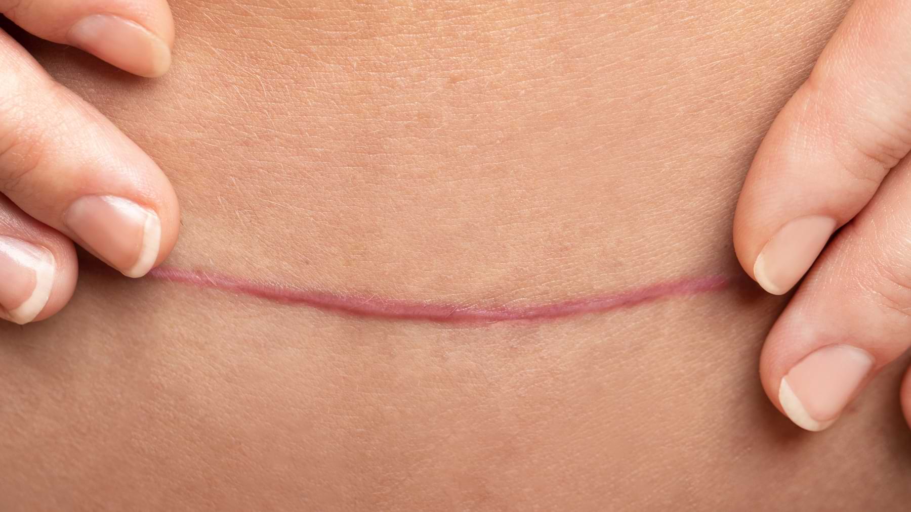 Close-up of a healed surgical scar on the skin, gently held on both sides by two fingers.