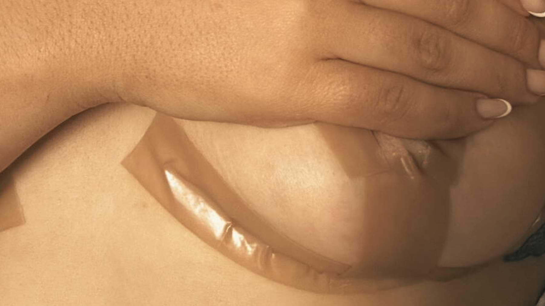A close-up of a breast with silicone scar tape applied under the breast crease, partially covered by a hand.