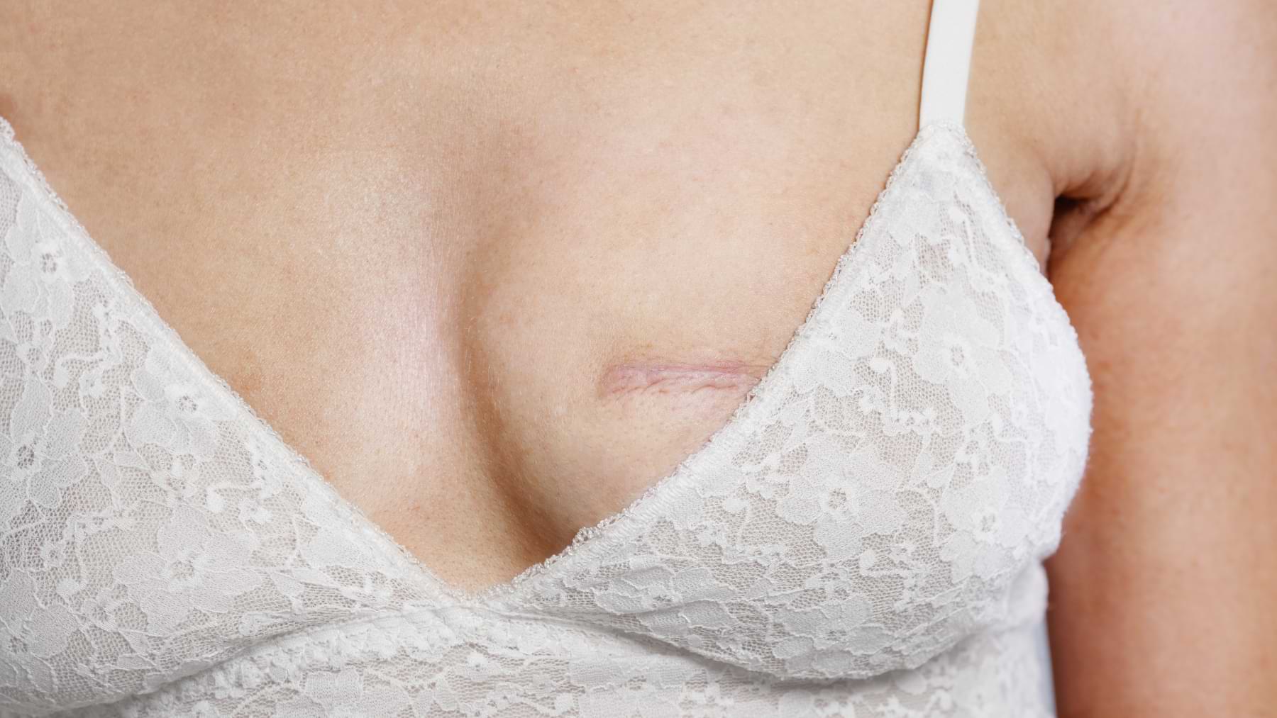 Close-up of a healed scar on a woman’s breast, partially covered by a white lace bra.