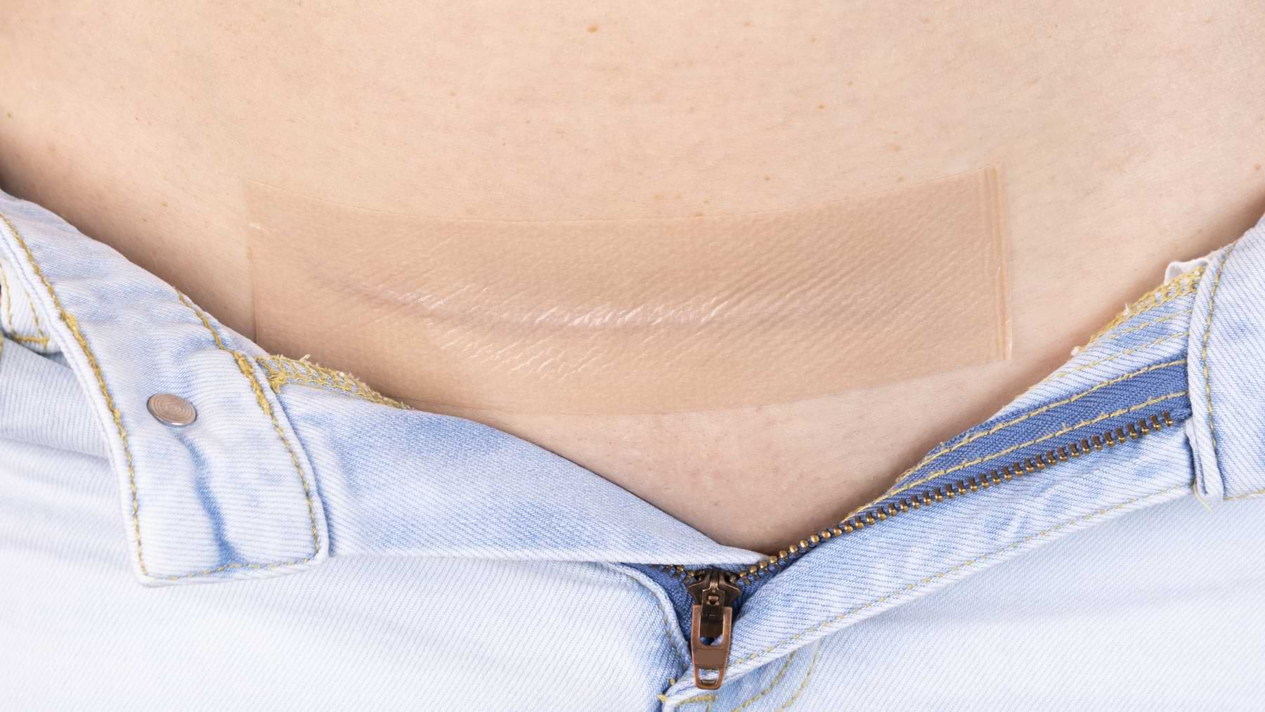 Person peeling off a piece of silicone scar tape from a lower abdominal scar, likely a post-C-section application.