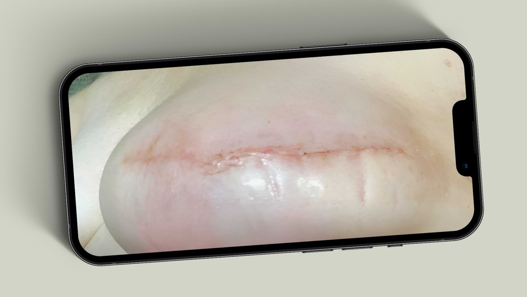 Close-up of a healing post-surgical scar on the lower breast, shown slightly raised and red with a shiny balm applied.