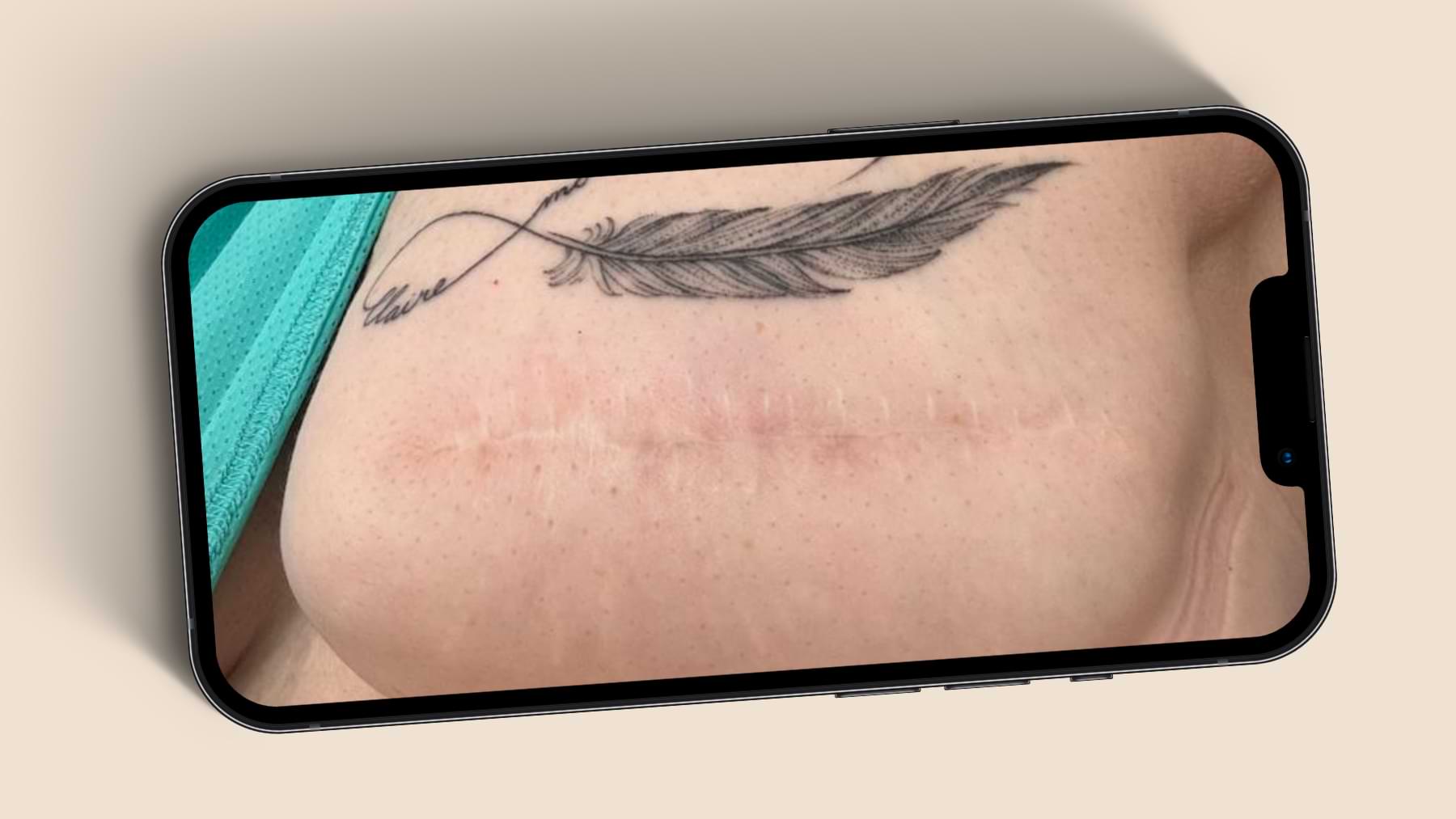 Close-up of the same area showing a well-faded scar beneath a tattoo, with smoother, more even skin tone and texture.