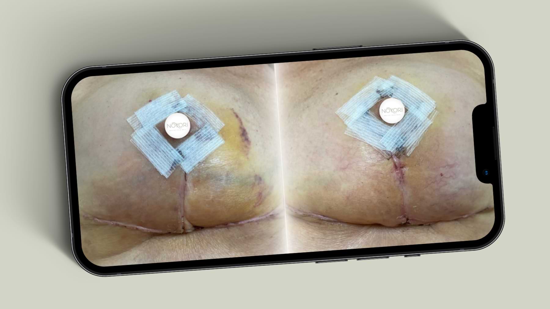 Before and after of post-surgery breast with visible healing and reduced bruising.