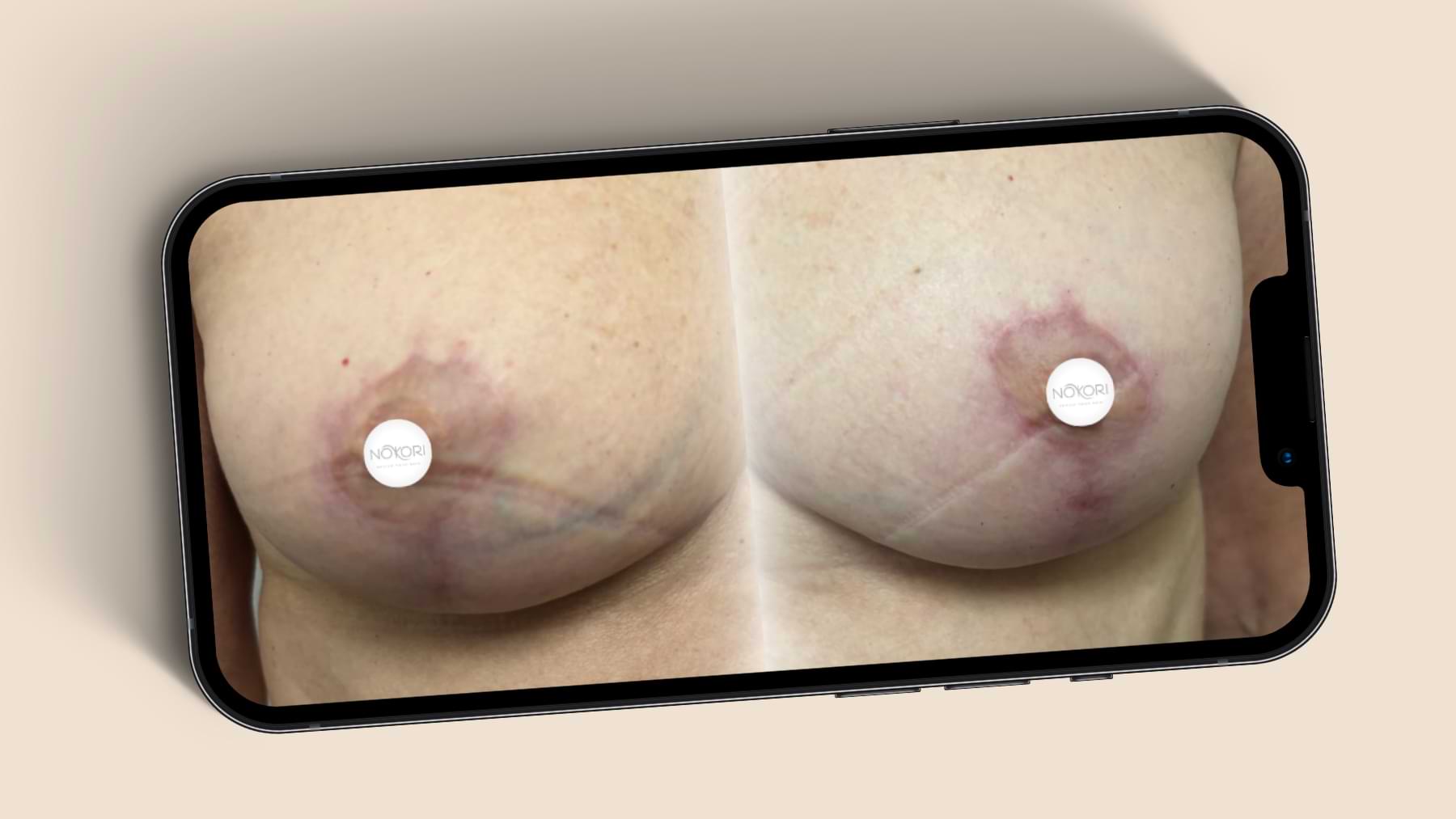 Comparison of breast scars showing reduced redness and improved appearance.