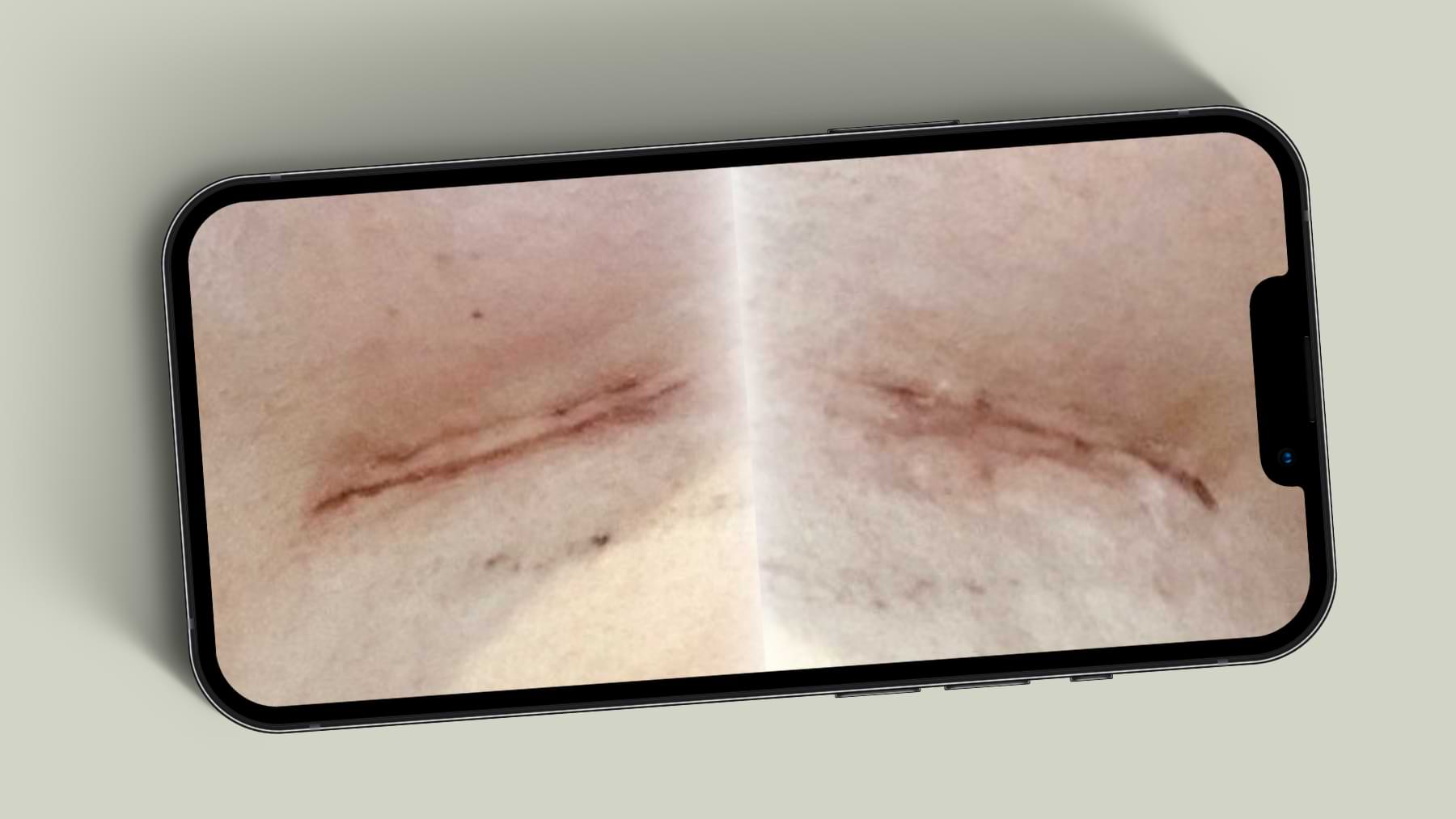 Healing progress of inframammary scar from raised to smoother.