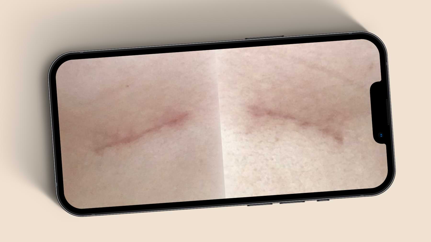 Faded surgical scar under breast, lighter and less visible over time.