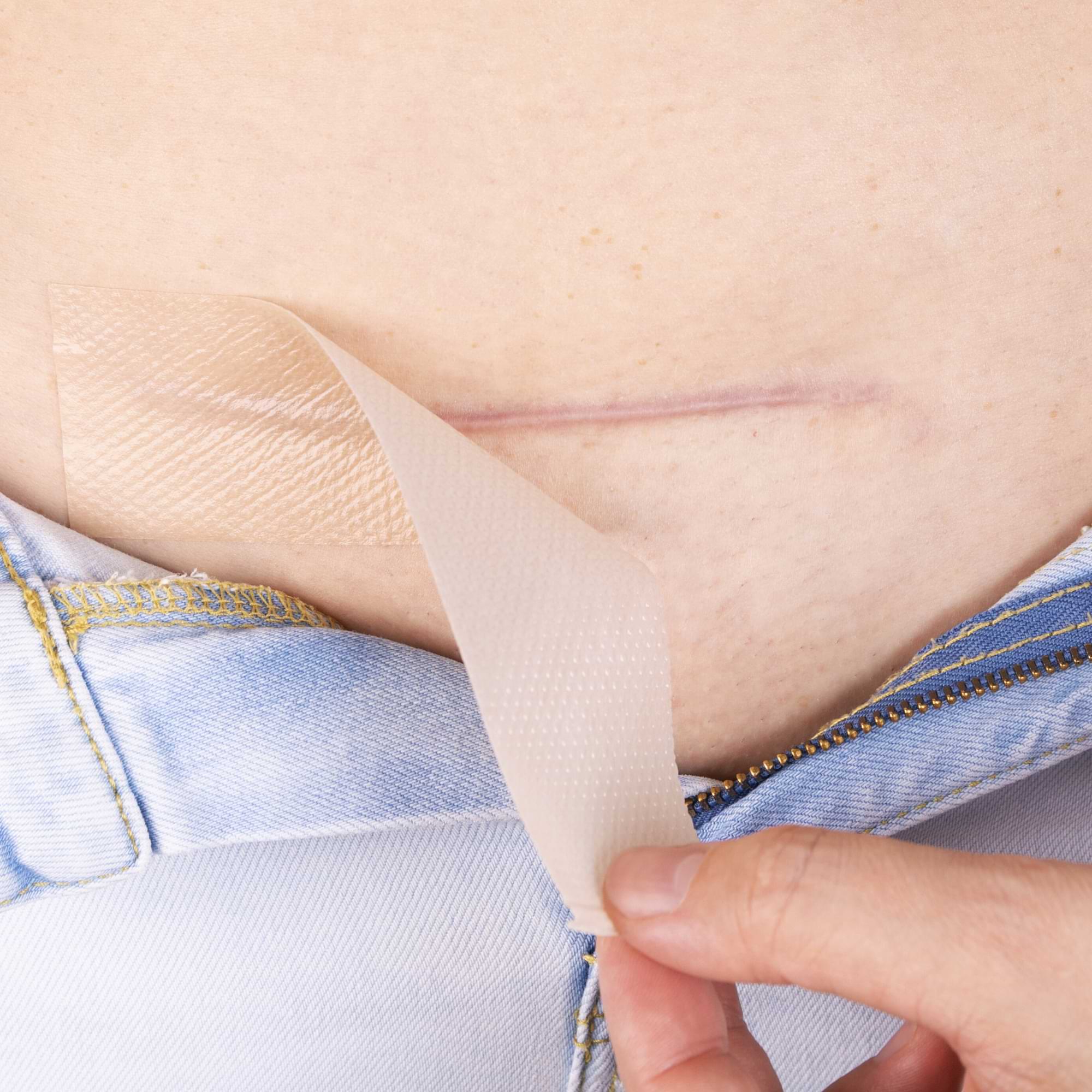 Person peeling off a piece of silicone scar tape from a lower abdominal scar, likely a post-C-section application.