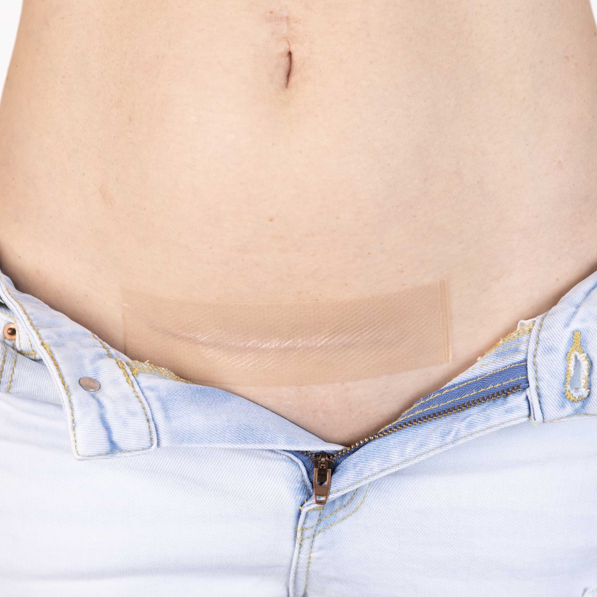 A close-up of a c-section scar on the lower abdomen with a translucent silicone strip applied, just above the waistband of light denim jeans.