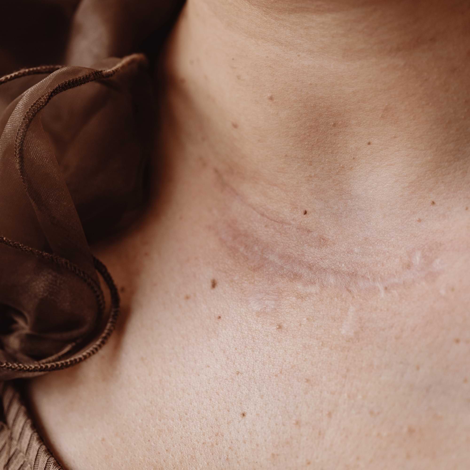 Healed scar at the base of the neck—subtle and gently fading, representing progress in recovery.