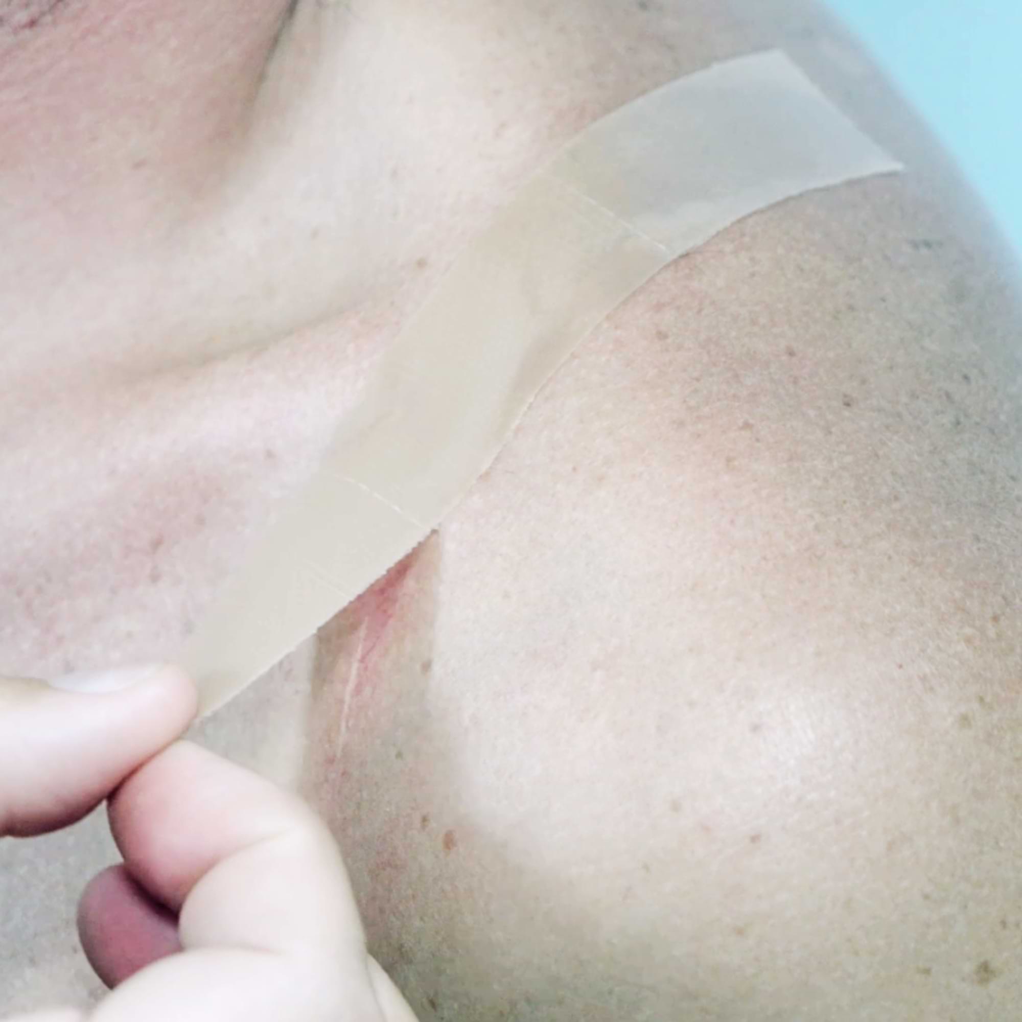 Nokori Scar Tape applied to a healing scar on the shoulder, showing its transparent and skin-blending finish.