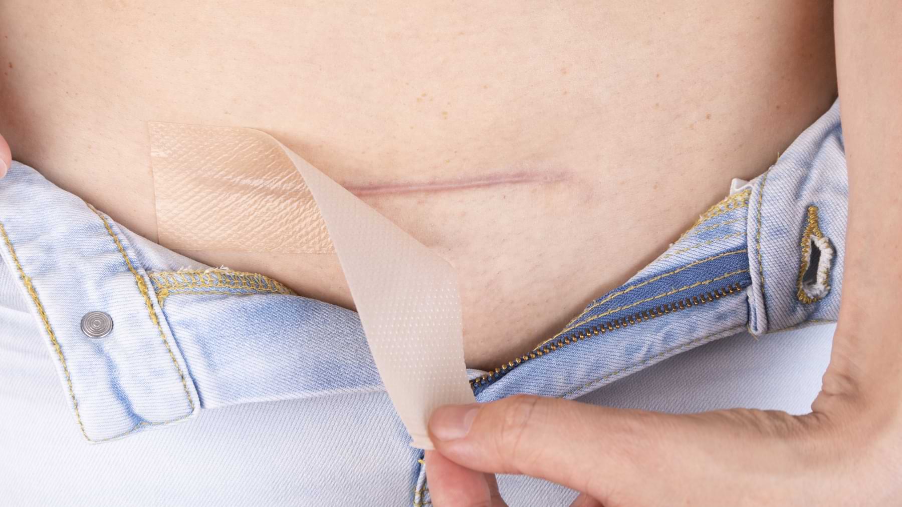Person peeling off a piece of silicone scar tape from a lower abdominal scar, likely a post-C-section application.