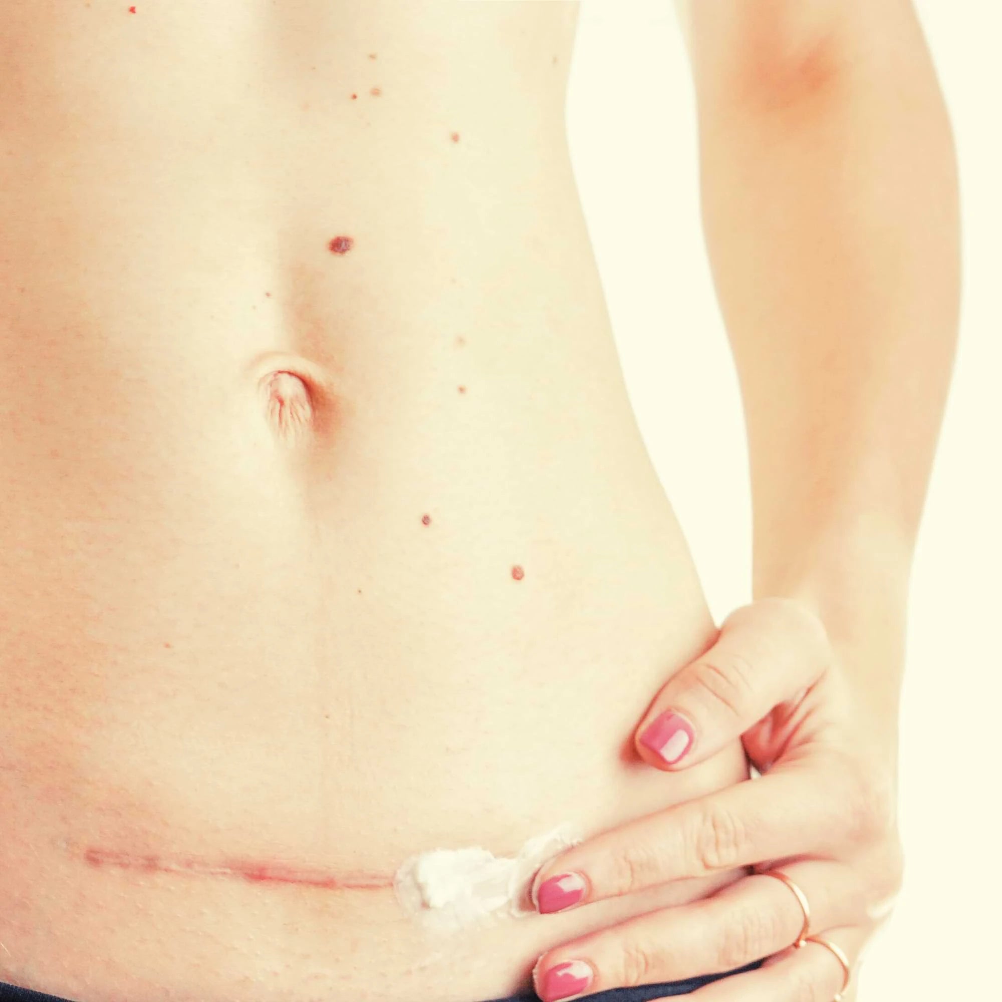 Essential Scar Care for Your Recovery Journey – Nokori