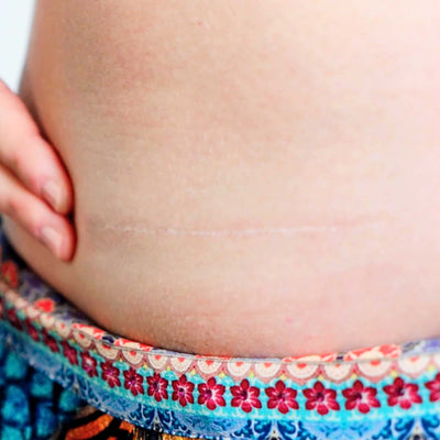 Healed faint C-section scar on lower abdomen, shown just above a patterned garment.